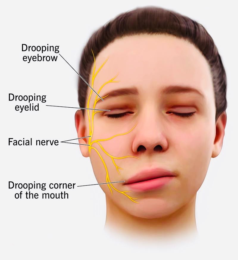 Bells Palsy